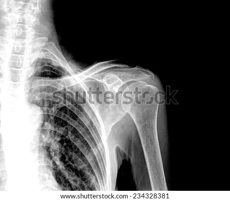 X-ray of a fractured upper arm, anterior-posterior view