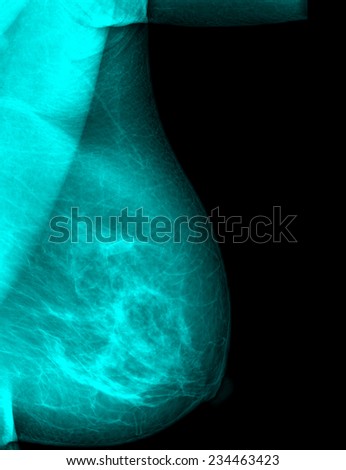 mammography breast scan X-ray image