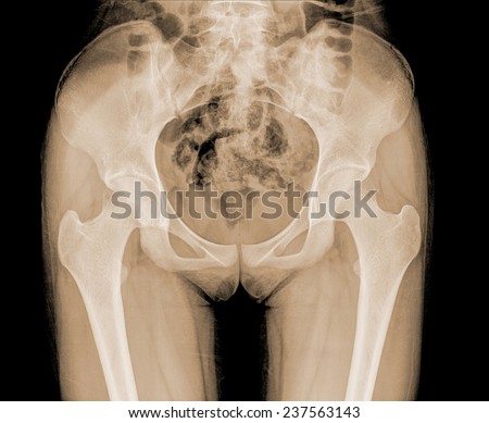 X ray film of pelvic bone