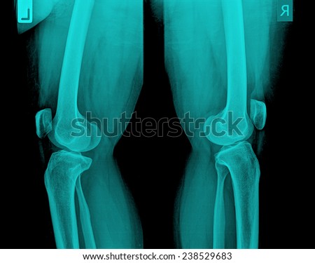 X-ray of painful knee - side view