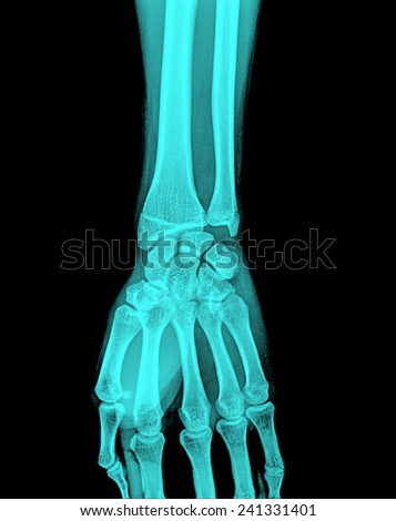 X-ray of human hand and wrist.