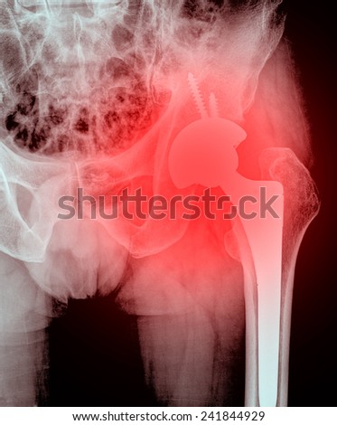 xray of hip replacement surgery, good outcome