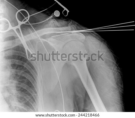 X-ray film of shoulder from portable machine in operation room