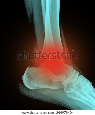 painful human right foot ankel xray picture (external side)
