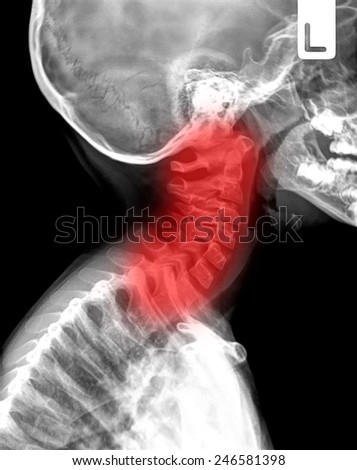 x-ray of neck, painful,side view