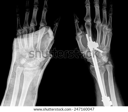 xray of fracture wrist and chronic infection. It was operated and external fixed by plate and screw , top view