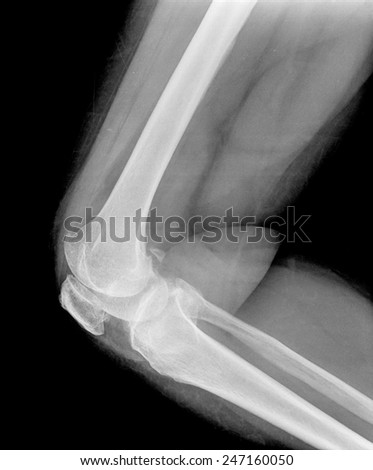 Xray of a human knee isolated