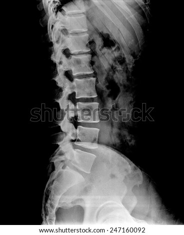 X-ray lumbo-sacral spine and pelvis of asian adult people ,side view