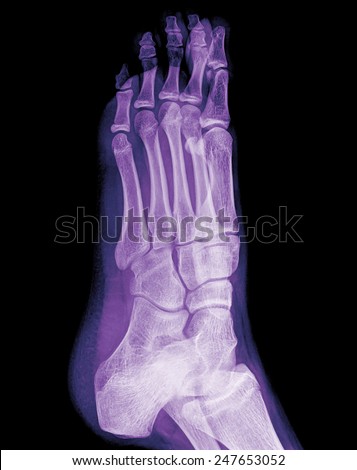 x-ray of foot , side view