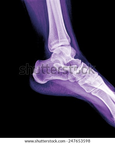 human foot ankle closeup and xray picture
