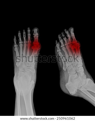 xray of patient show big toe painful