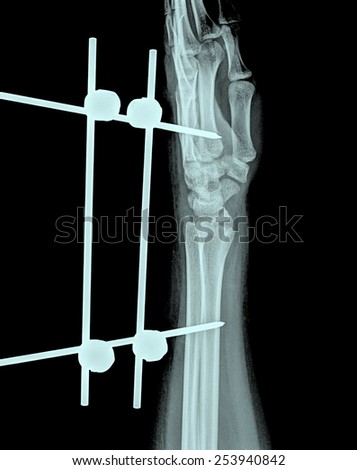 xray of fracture wrist and chronic infection. It was operated and external fixed by plate and screw