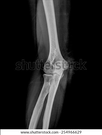 elbow x-rays ( Elbow joint Antero-posterior )on a black background