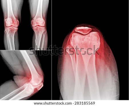 collection of xray of normal a human knee , painful