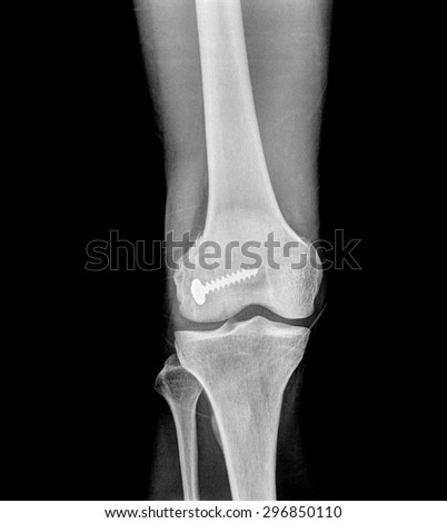X Rays image broken knee joint with screw ,Image x-rays painful of knee joint