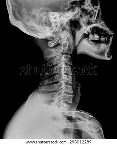 X-ray of bone neck