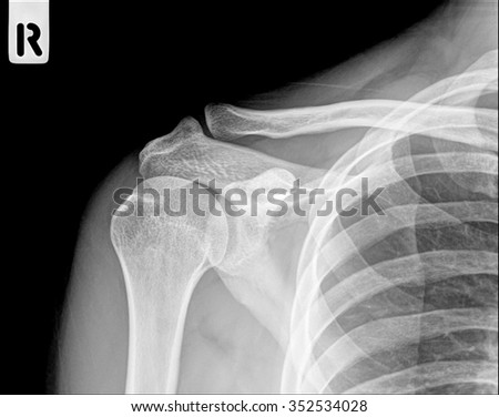 X-Ray Of A Fractured Upper Arm, Anterior-Posterior View (Shouder Bone X ...