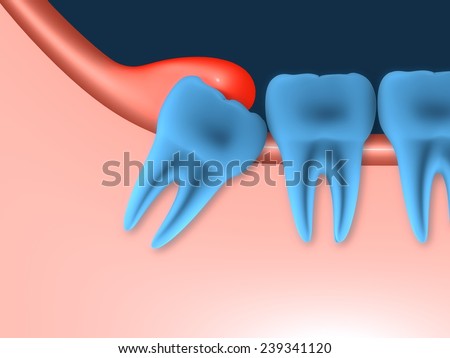 Problems caused by impacted wisdom teeth include.Infection