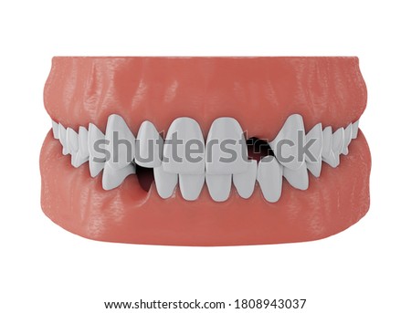 jaw with missing front upper tooth deuce and lower tooth three on white background, 3d render Zdjęcia stock © 