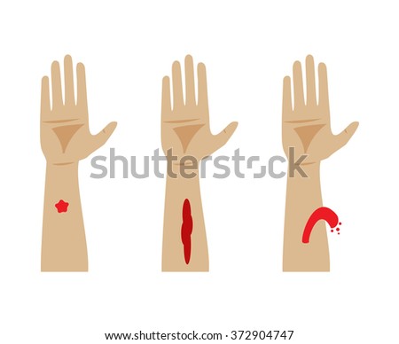 Types Of Bleeding. Capillary, Venous And Arterial Bleeding Stock Photo ...