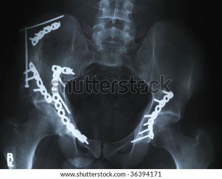 An Xray Of A Broken Pelvis/Hip With Metal Pins Holding It Together ...