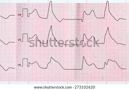 Emergency Cardiology. Tape ECG with acute period of macrofocal anterior myocardial infarction and ventricular bigemia
