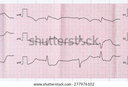 Emergency Cardiology. ECG with acute period macrofocal widespread anterior myocardial infarction and ventricular premature beats