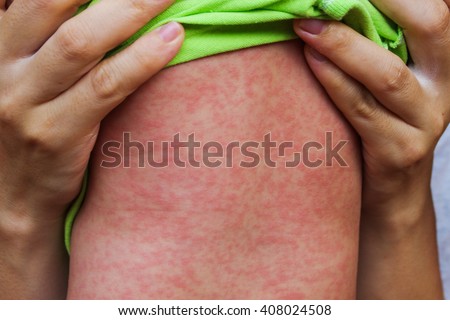 Image, Stock Photo Measles or rubeola rash on Caucasian man’s skin