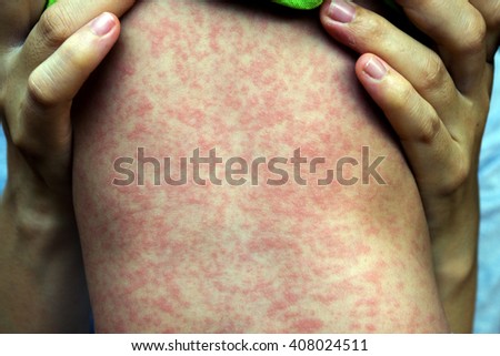 Similar – Image, Stock Photo Measles or rubeola rash on Caucasian man’s skin