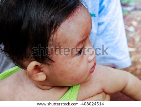 Similar – Image, Stock Photo Measles or rubeola rash on Caucasian man’s skin