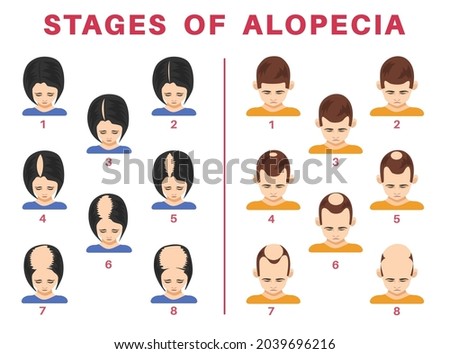 Stages of alopecia in men and women vector illustrations set. Tops of male and female heads with bald spots on scalps isolated on white background. Health, hair loss or treatment concept