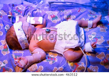 Premature baby boy, born six & half weeks premature, in hospital Neo Natal Intensive Care Unit, undergoing phototherapy with ultra violet lighting to treat Jaundice condition
