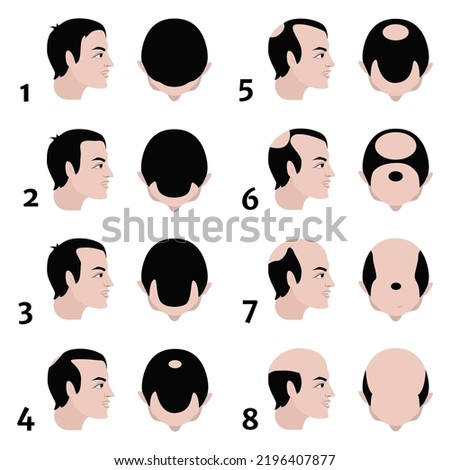 Stages of baldness according to the Norwood scale. Vector flat illustration
