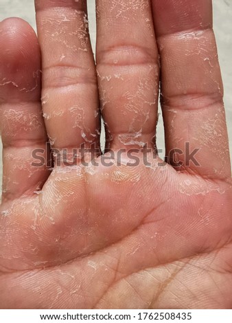 Skin peeling desquamation of hand and fingers. Foto d'archivio © 