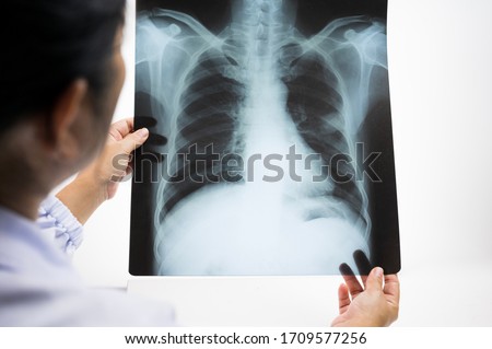 stock photo woman doctor hands holding patient chest x ray film before treatment image lung at radiology 1709577256
