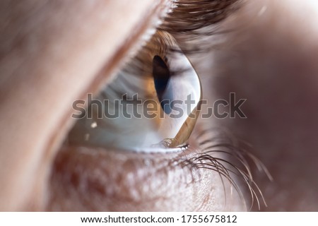 Macro eye photo. Keratoconus - eye disease, thinning of the cornea in the form of a cone. The cornea plastic.