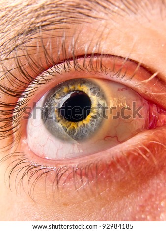 Bicolor Eye Of Young Man Stock Photo 92984185 : Shutterstock