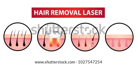Hair removal laser icon step vector illustration