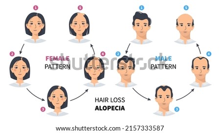 Hair loss stages, androgenetic alopecia male and female pattern. Steps of baldness vector circle infographic in a flat style with a man and a woman. Changing the hairline on the scalp