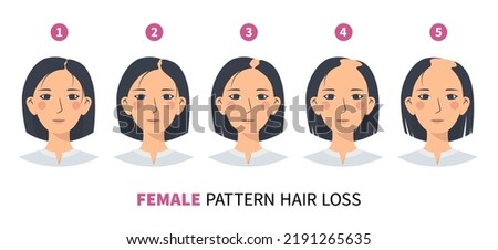 Hair loss stages, androgenetic alopecia female pattern FPHL. Steps of baldness vector infographic in a flat style with a woman.