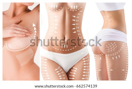 The cellulite removal plan. White markings on young woman body Foto stock © 