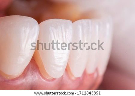 Try in procedure of dental ceramic veneers for lower teeth before installation. Porcelain laminated veneers for whiten and smile makeover.
