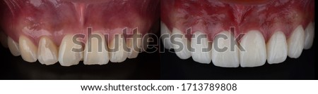 Full mouth smile makeover with dental ceramic veneers treatment, present of clean, perfect, youth and white teeth smile. Before and after close upper teeth.