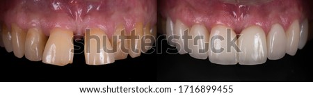 Dental crown and veneer before and after. Smile makeover with dental ceramic veneers treatment, result in clean, well aligned,perfect, youth and white teeth smile. 
