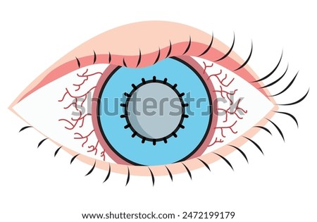 Mucous membrane pemphigoid,Cicatricial,chronic autoimmune causing blistering and scarring of the mucous membranes, including the eyes,Stevens-Johnson syndrom,ocular,Mooren's ulcer