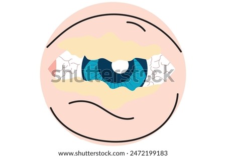 Mucous membrane pemphigoid,Cicatricial,chronic autoimmune causing blistering and scarring of the mucous membranes, including the eyes,Stevens-Johnson syndrom,ocular,Mooren's ulcer