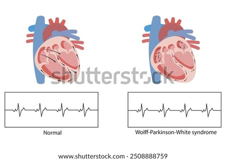 
Wolff-Parkinson-White syndrome ,heart condition causing rapid heartbeats due to an extra electrical pathway,atrial fibrillation, supraventricular tachycardia,and sudden cardiac arrest.