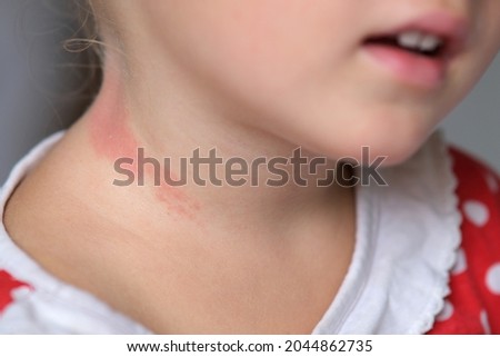 The neck of a little girl with a red allergic spot. Allergic reaction of a child to a food pathogen. Dermatitis of a small child for sweets. Zdjęcia stock © 
