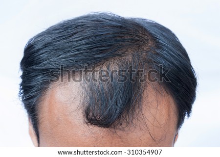 bald head of young man on  white background