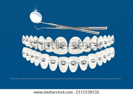 3d vector illustration, realistic teeth with braces upper and lower jaw. Alignment of the bite of teeth, dentition with braces, dental braces.
